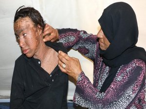 Suriyeli genç balık pulu hastalığıyla mücadele ediyor