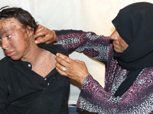 Suriyeli genç balık pulu hastalığıyla mücadele ediyor