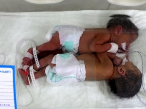 Yapışık ikizler dünyaya geldi