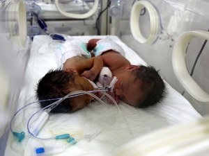 Şanlıurfa'da siyam ikizi bebekler ameliyatla ayrıldı