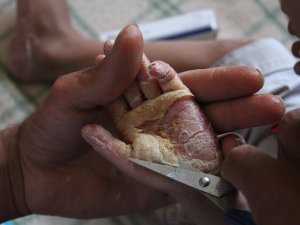 Suriyeli çocuğun iyileşmeyen hastalığı