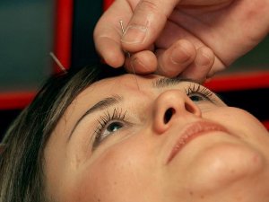 Depresyon ve bağımlılık tedavisine doğal destek: Akupunktur