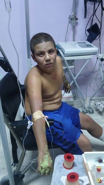 Çakmak gazı patlayınca 3 çocuk yaralandı