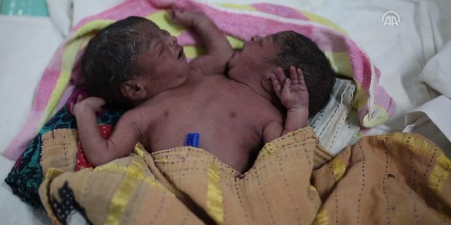 Bangladeş'te yapışık ikizler dünyaya geldi