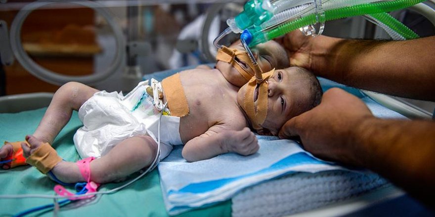 Gazze'de yapışık ikiz dünyaya geldi