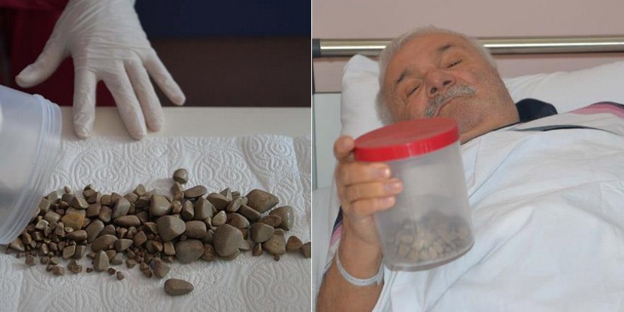 Mesanesinden binden fazla taş çıktı