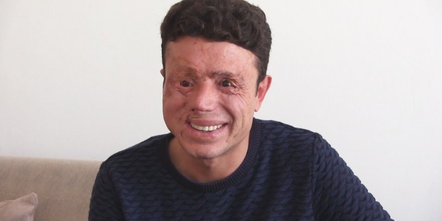 Gözlerini ve yüzünü kaybetti, gülüşünü kaybetmedi