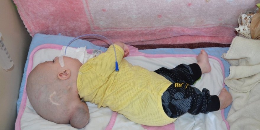 12 aylık Yunus Emre’nin yürek burkan dramı