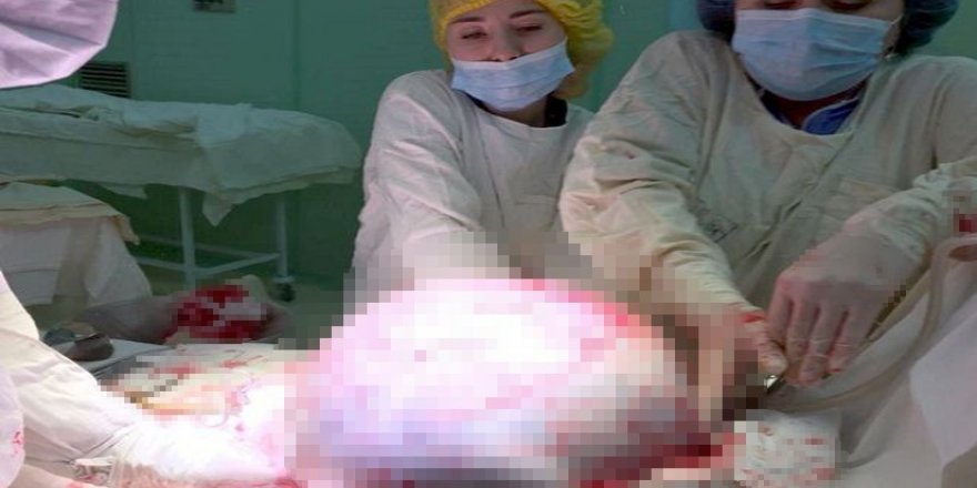 Rusya’da kadının yumurtalıklarından 25 kilogram tümör çıkarıldı