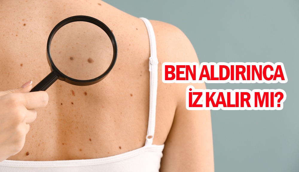 Ben Aldırınca İz Kalır Mı? Ben Aldırmadan Önce Bilinmesi Gerekenler Nelerdir?