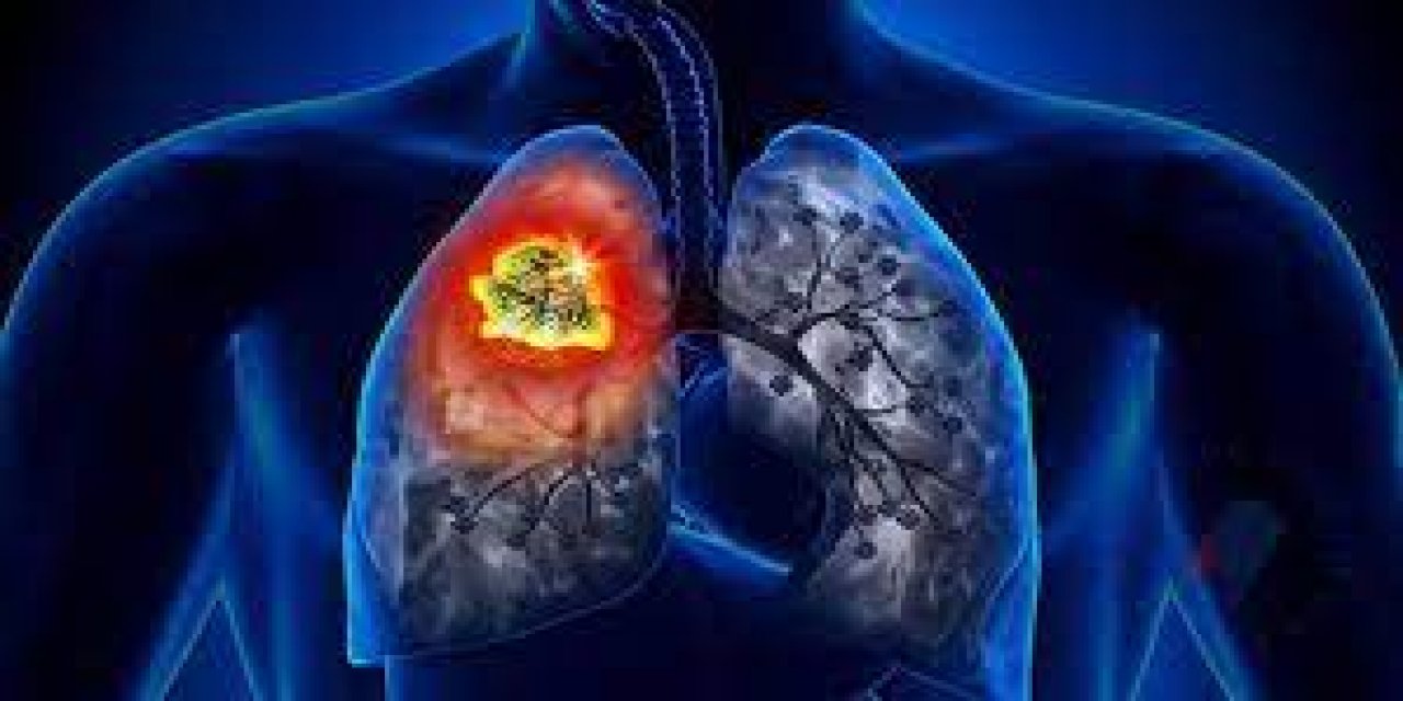 Akciğer kanserinin 8 belirtisi