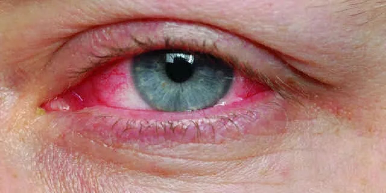 Kırmızı göz, göz nezlesi nedir? Göz sağlığını korumanın püf noktaları