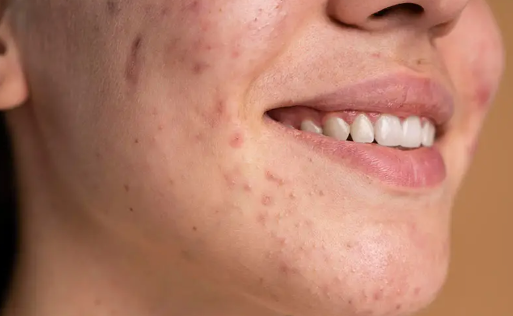 Akne Tedavisi Hakkında Bilmeniz Gerekenler