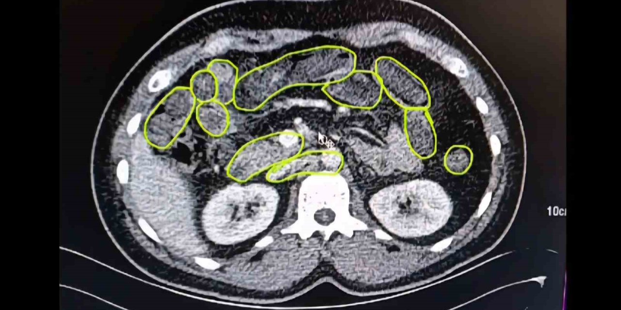 Mide ve bağırsaklarından bakın ne çıktı