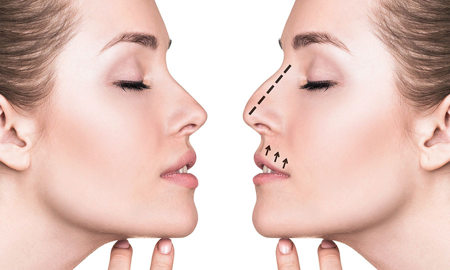 Burun Estetiği (Rinoplasti): Bilmeniz Gereken Her Şey