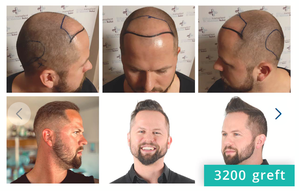 Saç Ekiminde Süreçler Nelerdir?