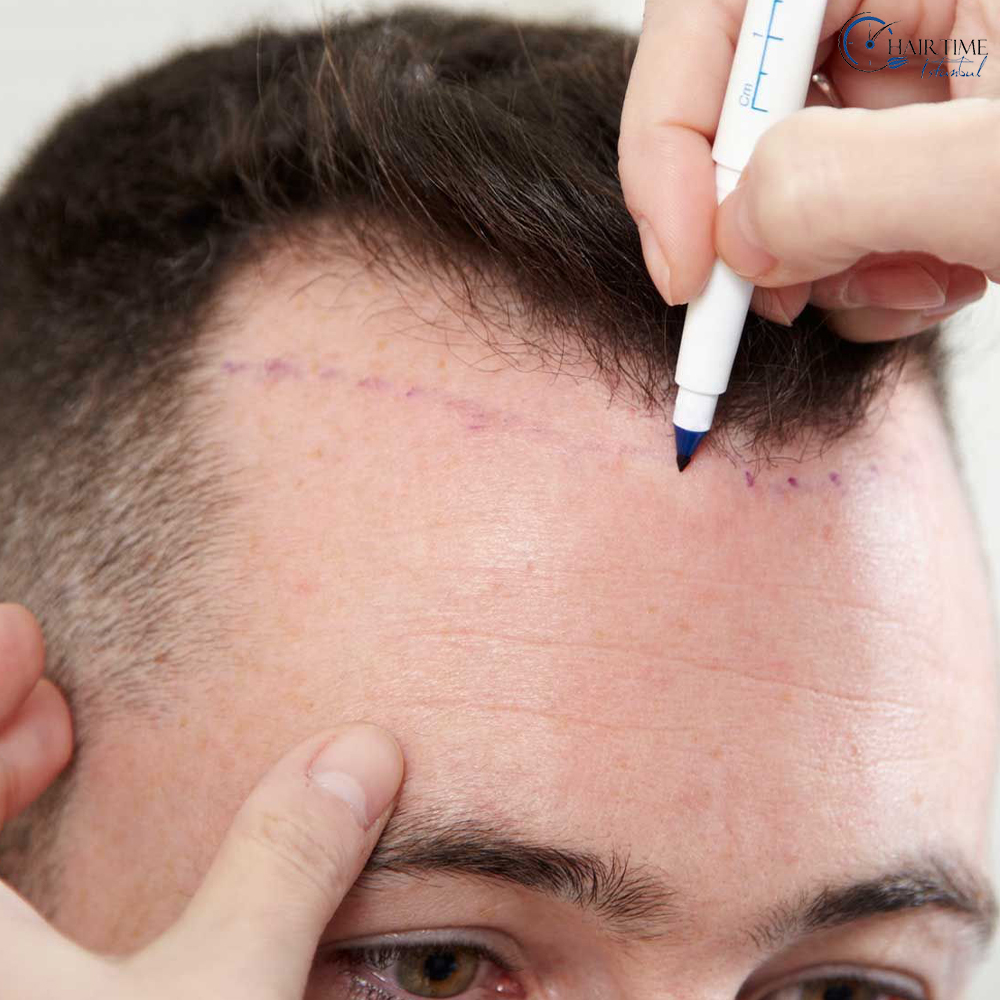 Gids voor Haartransplantatie in Nederland: Kunst, Technologie en Perfecte Resultaten (2025)