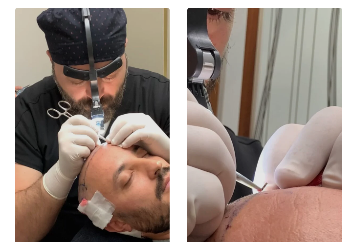 Sapphire DHI - SDHI Hair Transplant: Este Surgery