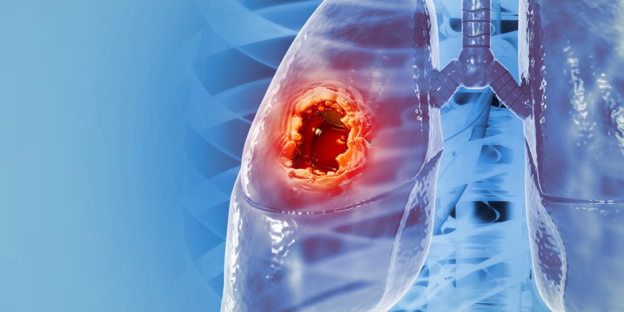 Akciğer kanseri erkeklerde daha fazla