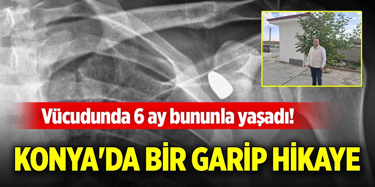 Vücudunda 6 ay bununla yaşadı! Konya'da bir garip hikaye