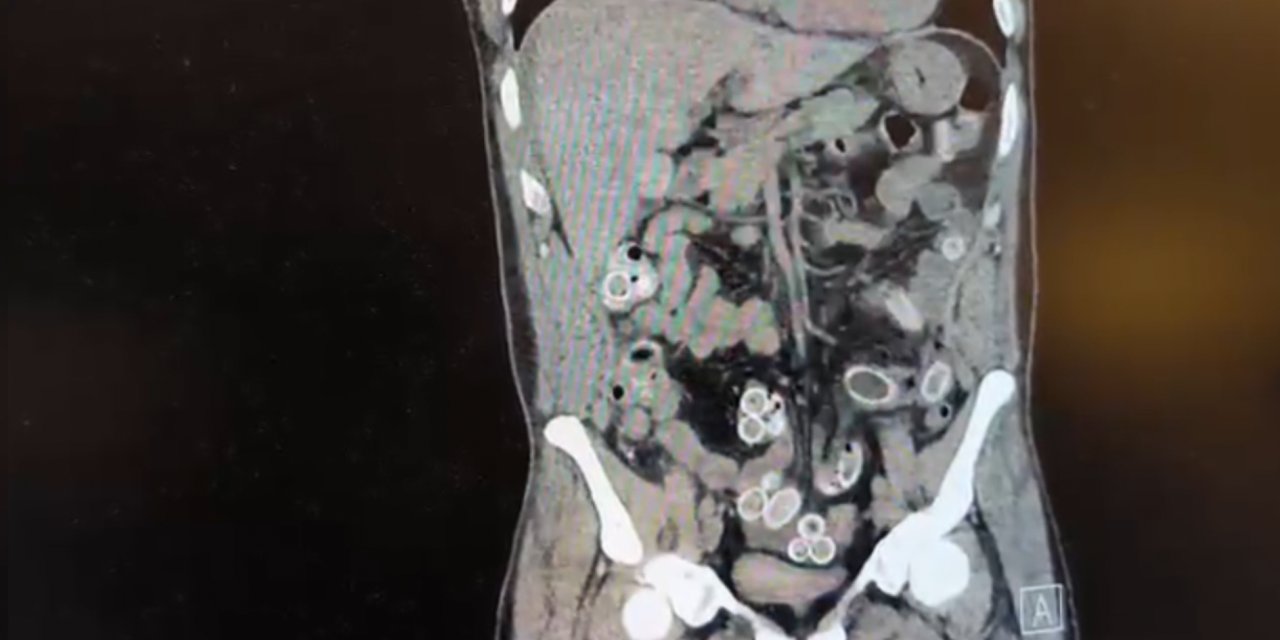 Midesinde uyuşturucu getirdi; ameliyatla çıkarıldı