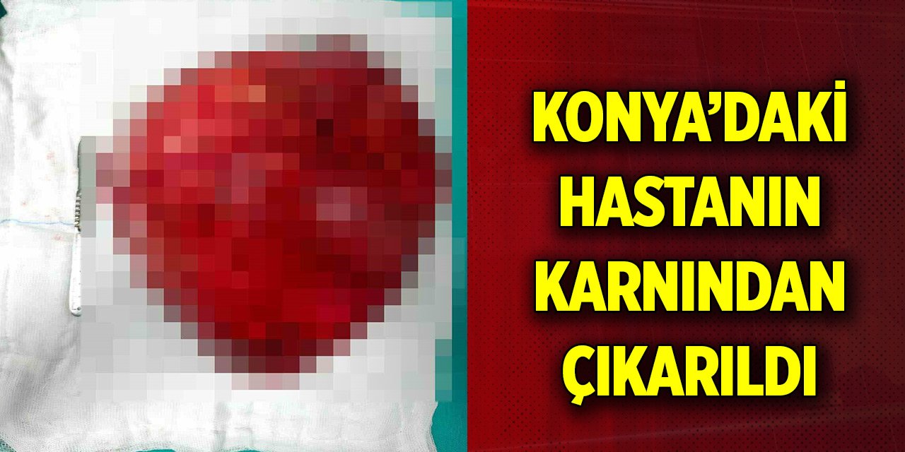 Konya'daki hastanın karnından çıkarıldı