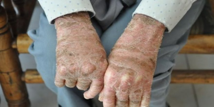 Bakan Koca'dan müjde! O ilaç Eylül'de piyasada