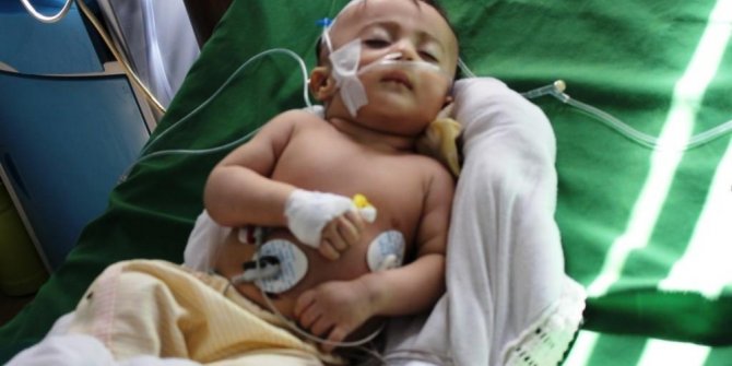 UNICEF: “400 binden fazla Yemenli çocuk, ileri derecede yetersiz beslenme sorunu yaşıyor”