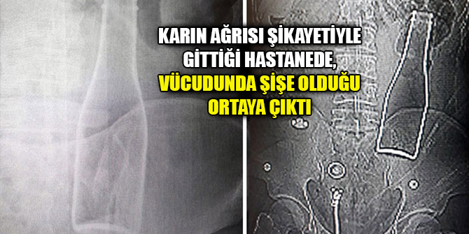 Karın ağrısı şikayetiyle gittiği hastanede, vücudunda şişe olduğu ortaya çıktı