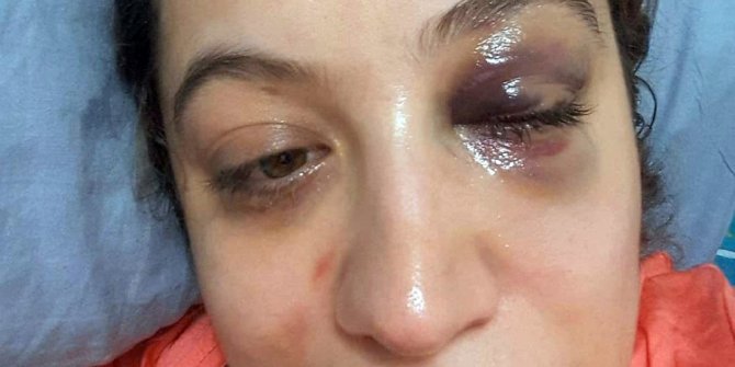 Eski eşi tarafından tehdit ve darp edilen kadın suç duyurusunda bulundu