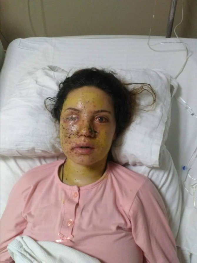 Eşi tarafından vurulan genç kadın gözünü kaybetti