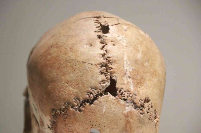 Dünyanın ilk beyin ameliyatı binlerce yıl önce Aksaray’da yapıldı