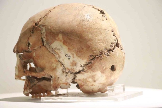 Dünyanın ilk beyin ameliyatı binlerce yıl önce Aksaray’da yapıldı