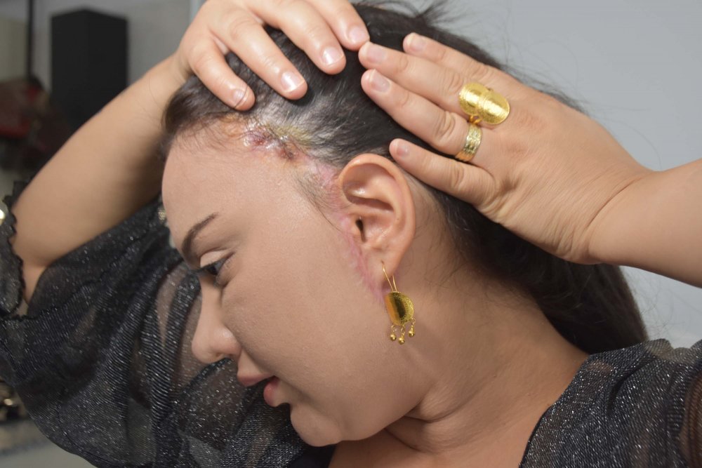 'Badem göz' ameliyatı hayatını kararttı