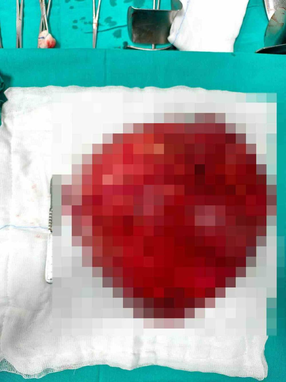 Konya'daki hastanın karnından çıkarıldı